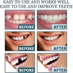 Löständer Temporära Falska Tänder För Omedelbart Självförtroende Leende, Tandfasader För Temporär Tandrestaureringa6> Tillbehör