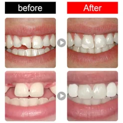 Tandfyllningssats Tillfällig Tandlim för Trasiga Tänder, Att Forma Hålen I Tanden, Halloween Smink Tandmodifiering><noscript><img width=