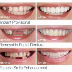 Yougang Boutique Smile Snap On Falska Tänder Övre Nedre Tandfasader Lösproteser Tandskydd Set_Speciella gåvor> Tillbehör